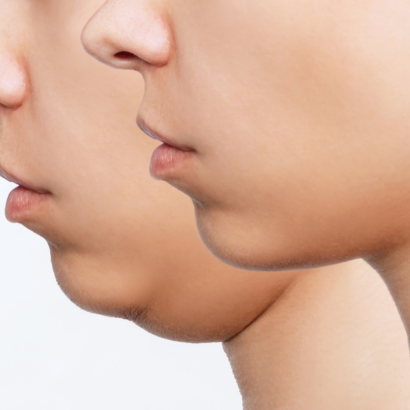 5 Best Double Chin Exercises To Reduce & Remove Naturally