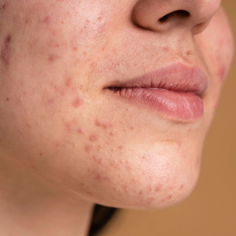 Period Acne